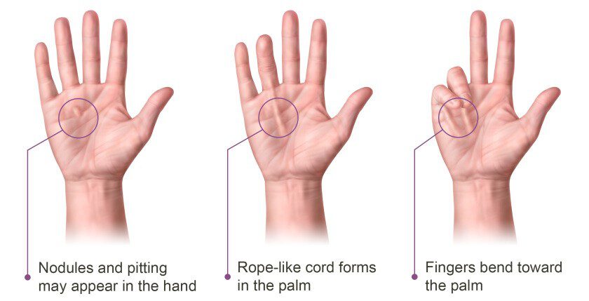 Midden voorkant tijdschrift Ziekte (Morbus) van Dupuytren (Vikings hand, Keltische klauw,  Koetsiershand) | Motion Fysiotherapie en Preventie